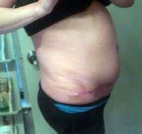 Abdominoplasty after weight loss after