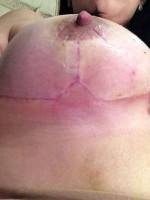 Abdominoplasty and breast augmentation