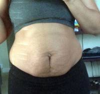 Abdominoplasty and muscle tightening