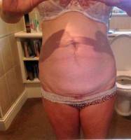 Abdominoplasty scars removal