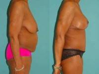 Am I a candidate for tummy tuck before and after