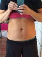 Am I a candidate for tummy tuck question photo