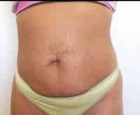 Am candidate for tummy tuck