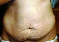 Before tummy tuck result photo