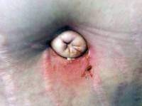 Belly button after abdominoplasty