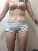 Belly button after abdominoplasty surgery