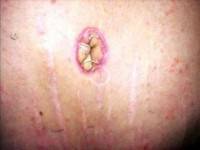 Belly button after tummy tuck image