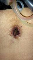 Belly button after tummy tuck image photo