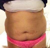 Best candidate for tummy tuck operation