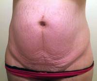 Best candidate for tummy tuck surgery