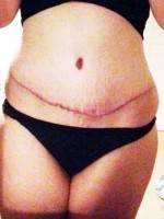 Best results from tummy tuck