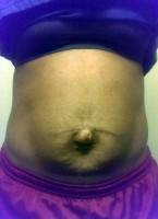 Can i have a abdominoplasty after c section
