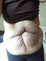 Can i have tummy tuck after c section