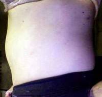 Candidate for tummy tuck surgery image