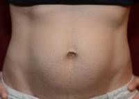 Floating abdominoplasty question