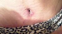 Full body tummy tuck photo bb after