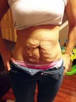 How long does a tummy tuck last question