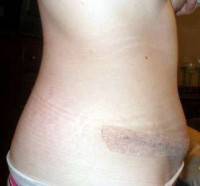 How long is recovery after tummy tuck photo
