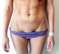 How long is recovery from tummy tuck operation