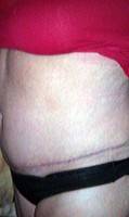 How long is recovery from tummy tuck photo