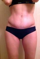 How long is recovery from tummy tuck question