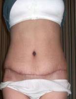 How long is recovery from tummy tuck surgery
