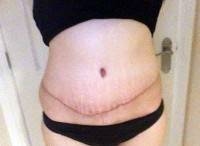How to get the best results from a tummy tuck operation