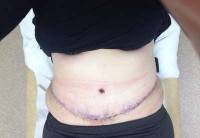 How to get the best results from abdominoplasty