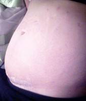Is possible abdominoplasty through c section scar