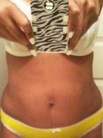 Is real tummy tuck with muscle tightening