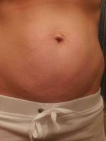 Lipo vs tummy tuck. Photo before pregnancy