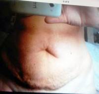 Liposuction tummy tuck image of patient