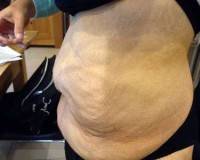 Liposuction tummy tuck photo
