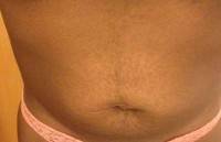 Liposuction versus tummy tuck photo