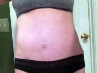 Liposuction versus tummy tuck scar