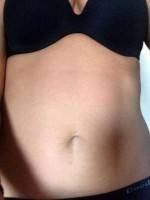 Liposuction with tummy tuck question
