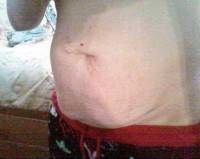 Liposuction with tummy tuck surgery