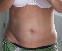 Lose weight after tummy tuck patient image
