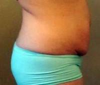 Lose weight after tummy tuck photo