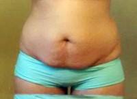 Lose weight after tummy tuck surgery