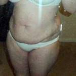 Lose weight before tummy tuck image