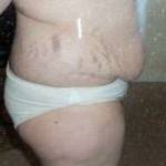Lose weight before tummy tuck photo