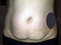 Mini vs Full abdominoplasty image of patient before