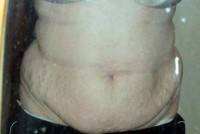 Need i Lose weight before tummy tuck