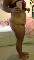 Photo before abdominoplasty after weight loss