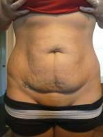 Photo of Candidates for tummy tuck