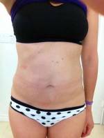 Photo of Liposuction with tummy tuck