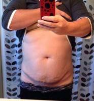Photo of candidate for tummy tuck surgery