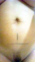 Photo of mini tummy tuck procedure