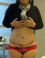 Recovery after tummy tuck surgery photo